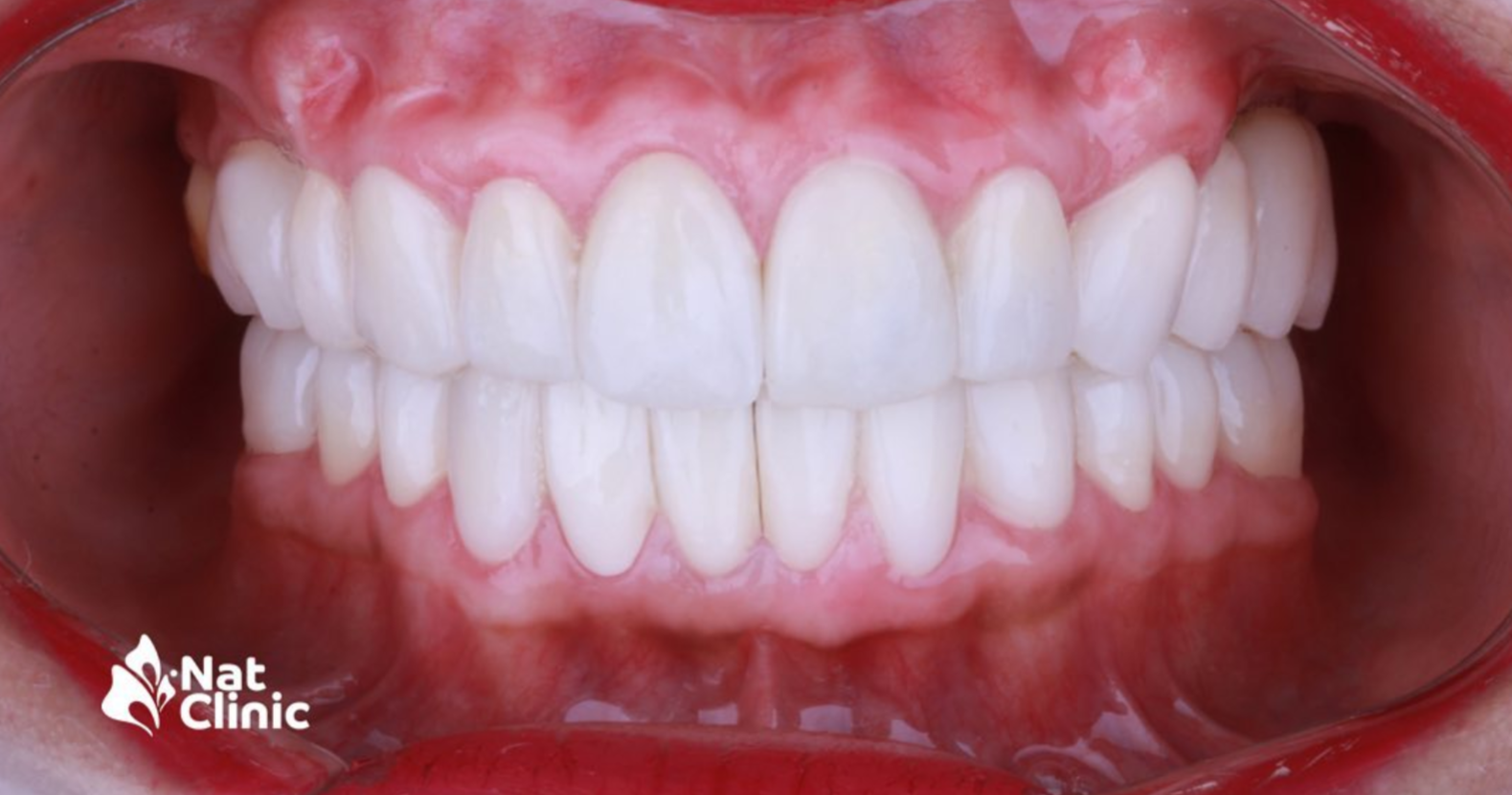 Diseño de sonrisa digital - Después